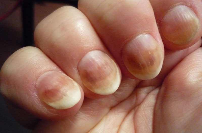 Проявление авитаминоза на руках и ногтях